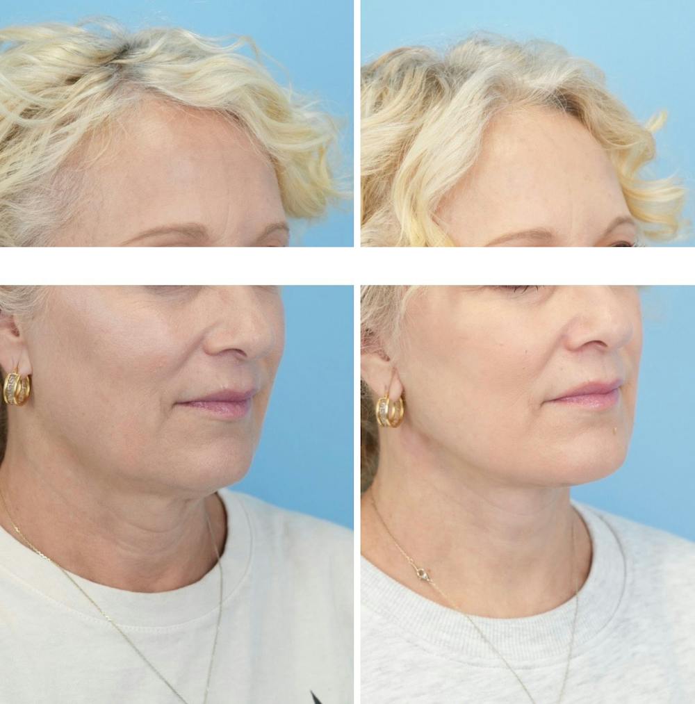 Facelift Before & After Gallery - Patient 124387 - Image 2