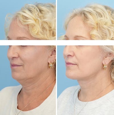 Facelift Before & After Gallery - Patient 124387 - Image 4