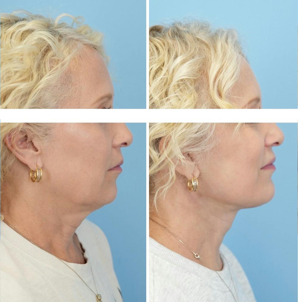 Facelift Before & After Gallery - Patient 124387 - Image 3