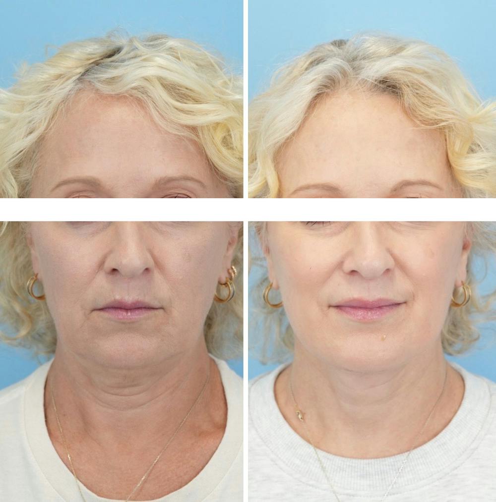 Facelift Before & After Gallery - Patient 124387 - Image 1