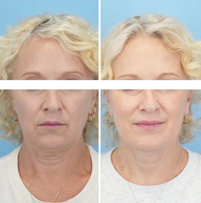 Facelift Before & After Gallery - Patient 124387 - Image 1