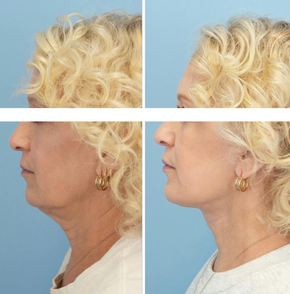 Facelift Before & After Gallery - Patient 124387 - Image 5