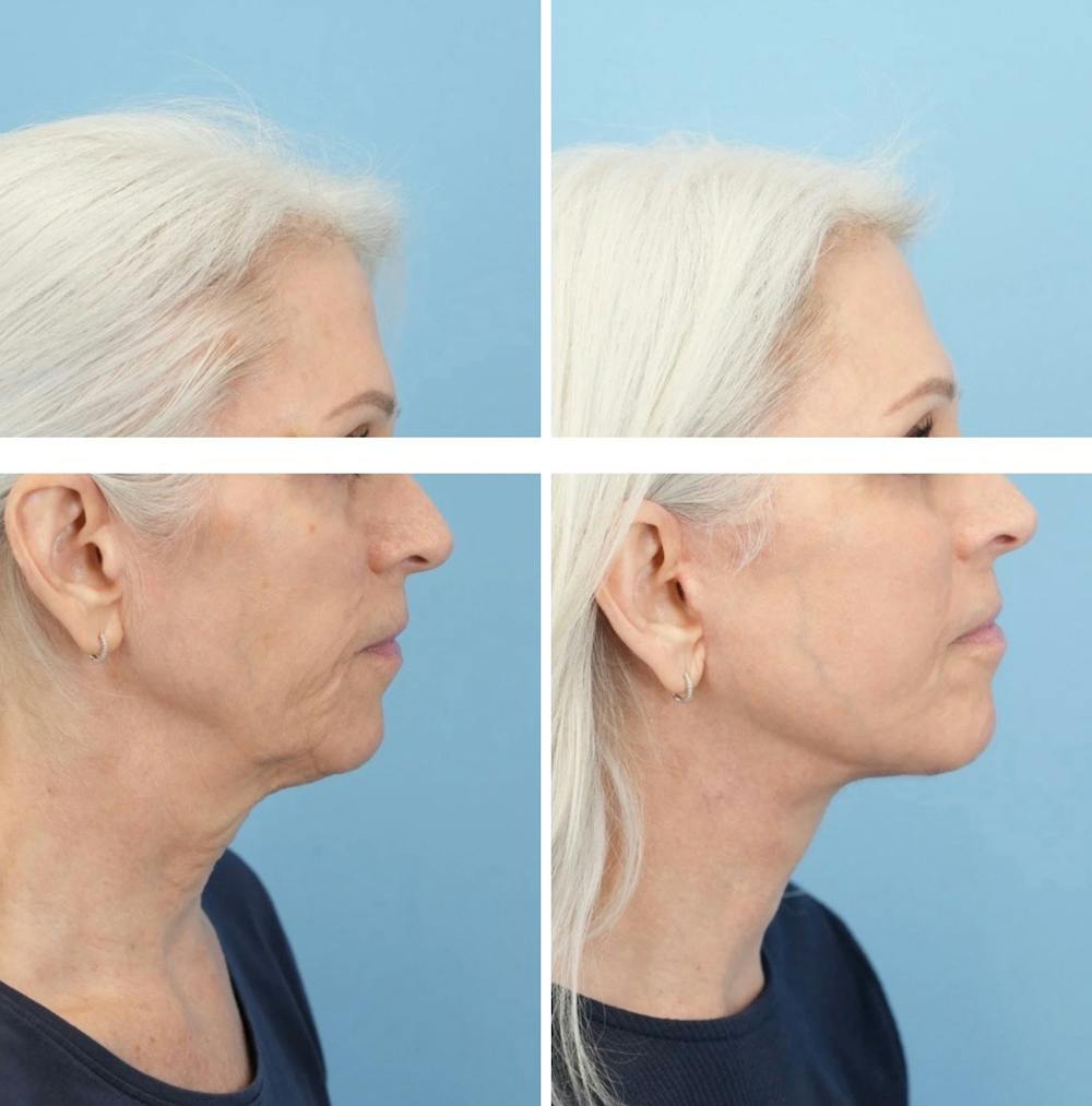 Facelift Before & After Gallery - Patient 568679 - Image 3