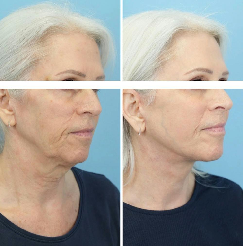 Facelift Before & After Gallery - Patient 568679 - Image 2