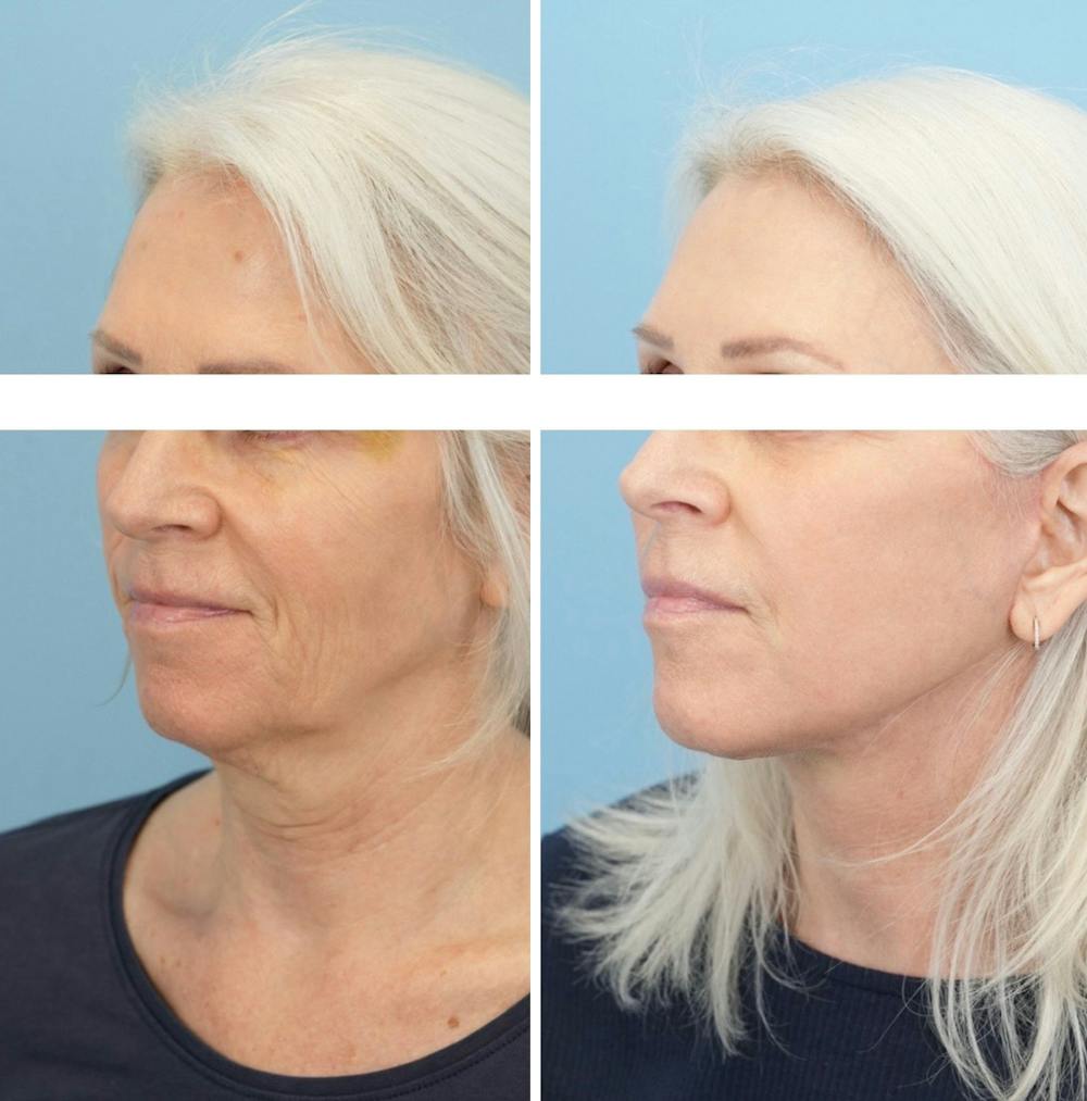 Facelift Before & After Gallery - Patient 568679 - Image 4