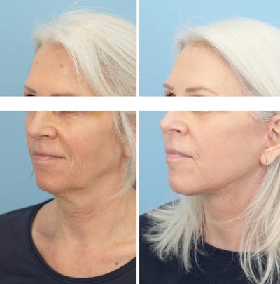 Facelift Before & After Gallery - Patient 568679 - Image 4