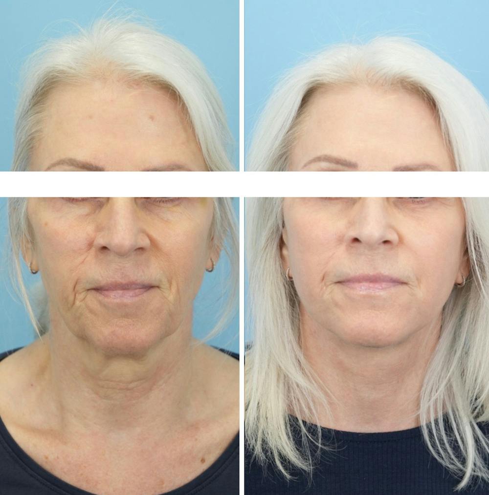 Facelift Before & After Gallery - Patient 568679 - Image 1