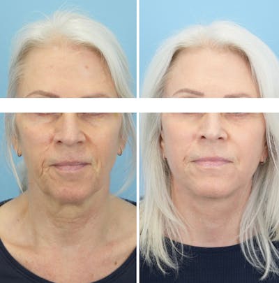 Facelift Before & After Gallery - Patient 568679 - Image 1