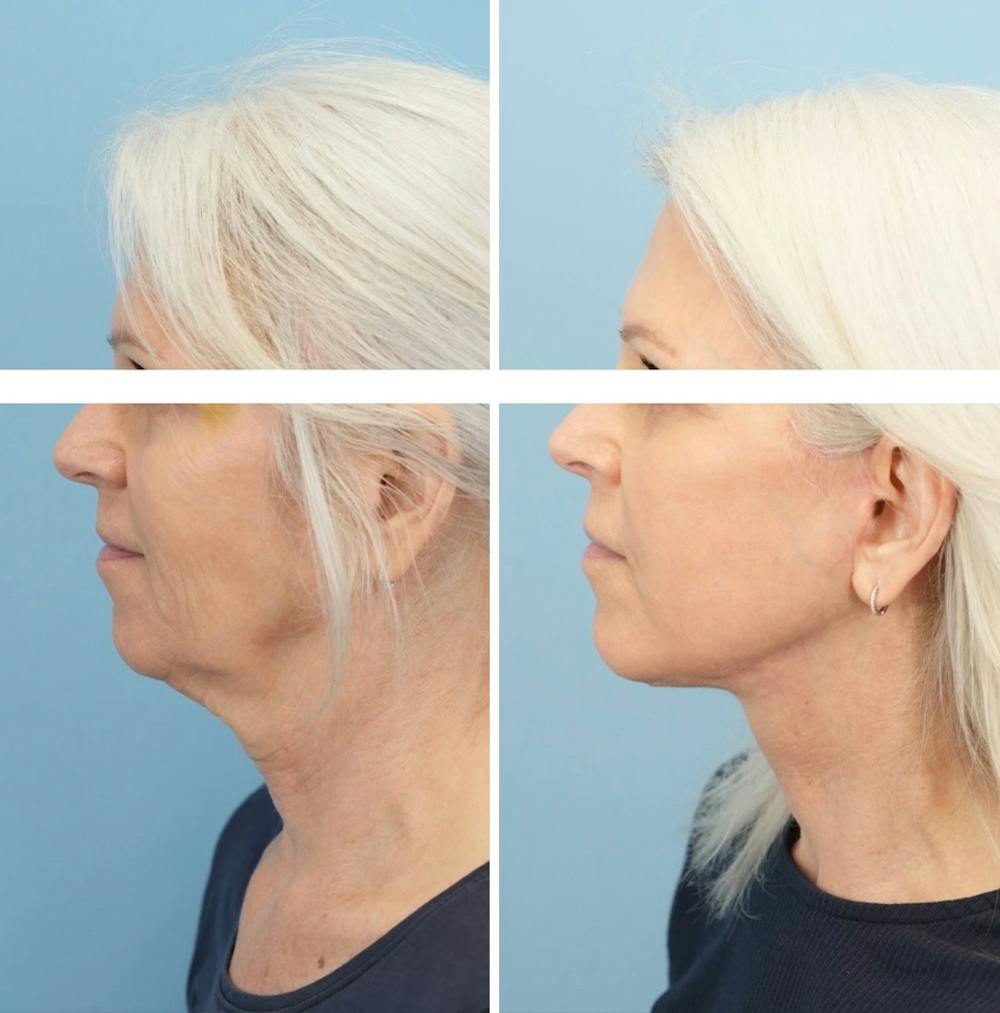Facelift Before & After Gallery - Patient 568679 - Image 5
