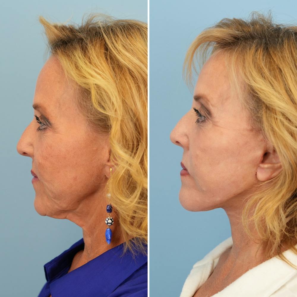 Facelift Before & After Gallery - Patient 207149 - Image 5