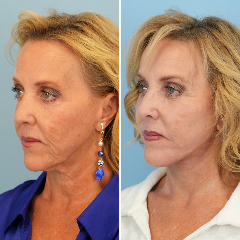 Facelift Before & After Gallery - Patient 207149 - Image 4