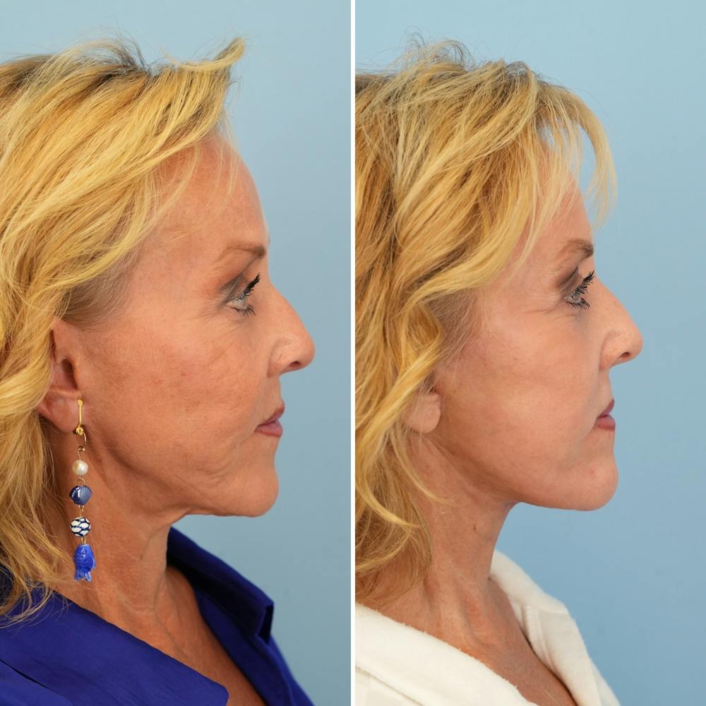 Facelift Before & After Gallery - Patient 207149 - Image 3