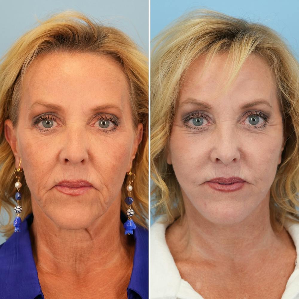 Facelift Before & After Gallery - Patient 207149 - Image 1