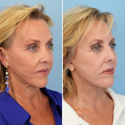 Facelift Before & After Gallery - Patient 207149 - Image 2