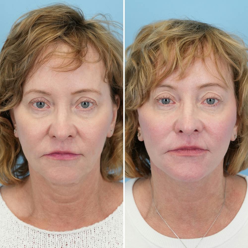 Facelift Before & After Gallery - Patient 204816 - Image 1