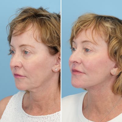 Facelift Before & After Gallery - Patient 204816 - Image 4