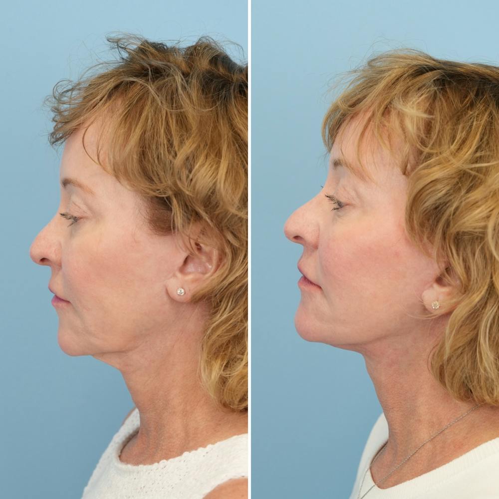 Facelift Before & After Gallery - Patient 204816 - Image 5