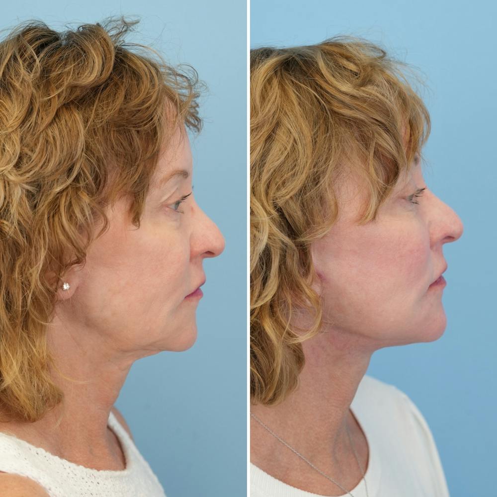 Facelift Before & After Gallery - Patient 204816 - Image 3
