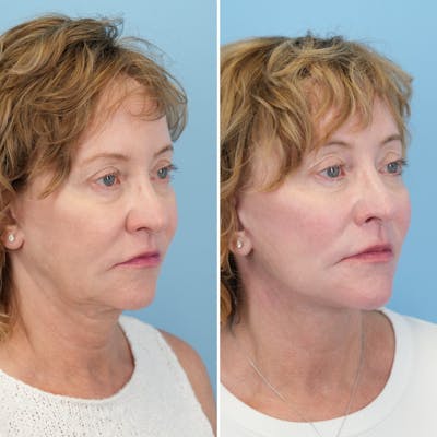 Facelift Before & After Gallery - Patient 204816 - Image 2