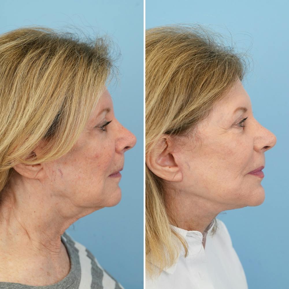Facelift Before & After Gallery - Patient 322127 - Image 3