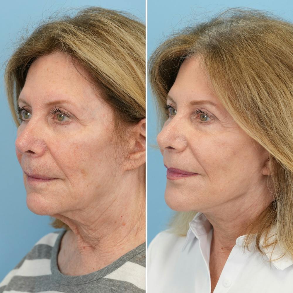 Facelift Before & After Gallery - Patient 322127 - Image 4