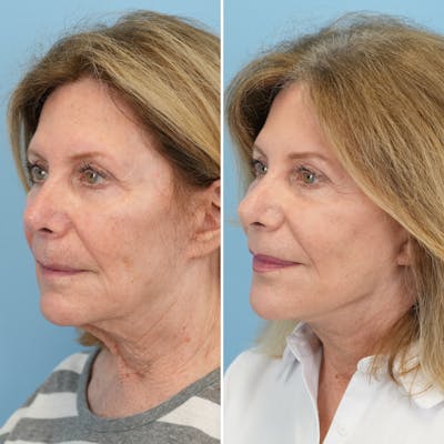 Facelift Before & After Gallery - Patient 322127 - Image 4