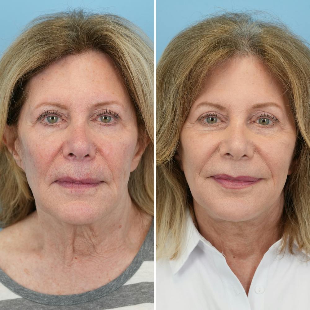 Facelift Before & After Gallery - Patient 322127 - Image 1