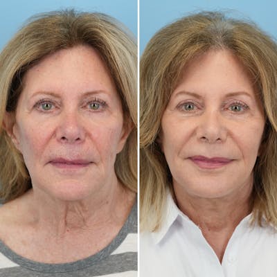 Facelift Before & After Gallery - Patient 322127 - Image 1
