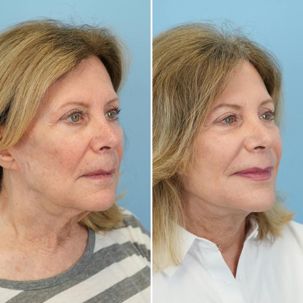 Facelift Before & After Gallery - Patient 322127 - Image 2