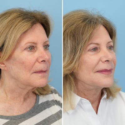 Facelift Before & After Gallery - Patient 322127 - Image 2