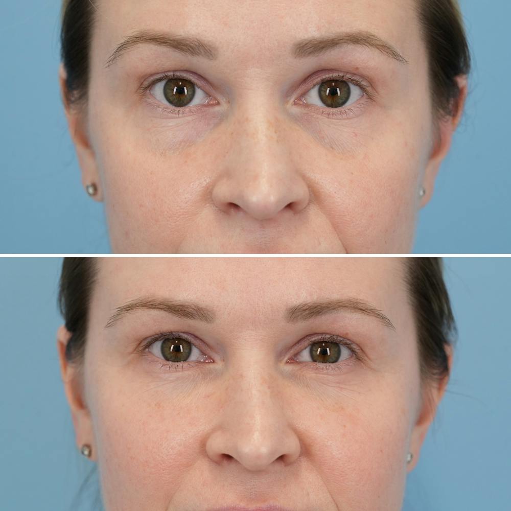 Blepharoplasty Before & After Gallery - Patient 197894 - Image 1