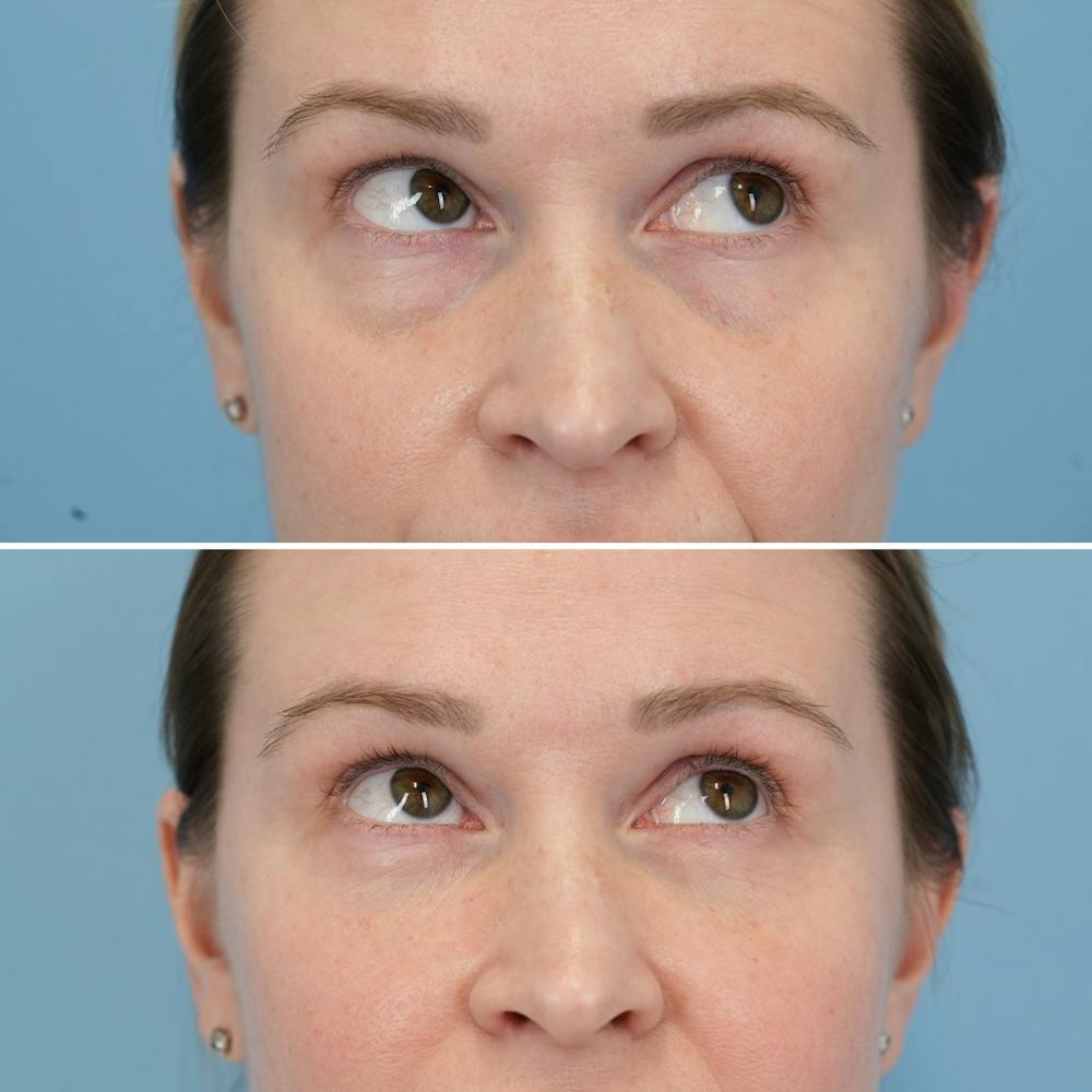 Blepharoplasty Before & After Gallery - Patient 197894 - Image 3
