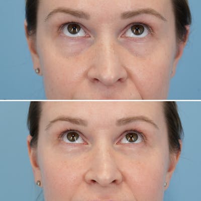 Blepharoplasty Before & After Gallery - Patient 197894 - Image 2