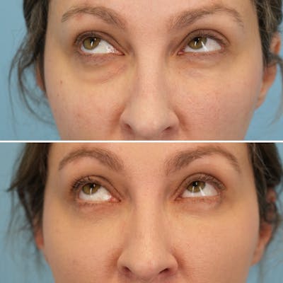 Blepharoplasty Before & After Gallery - Patient 369735 - Image 4