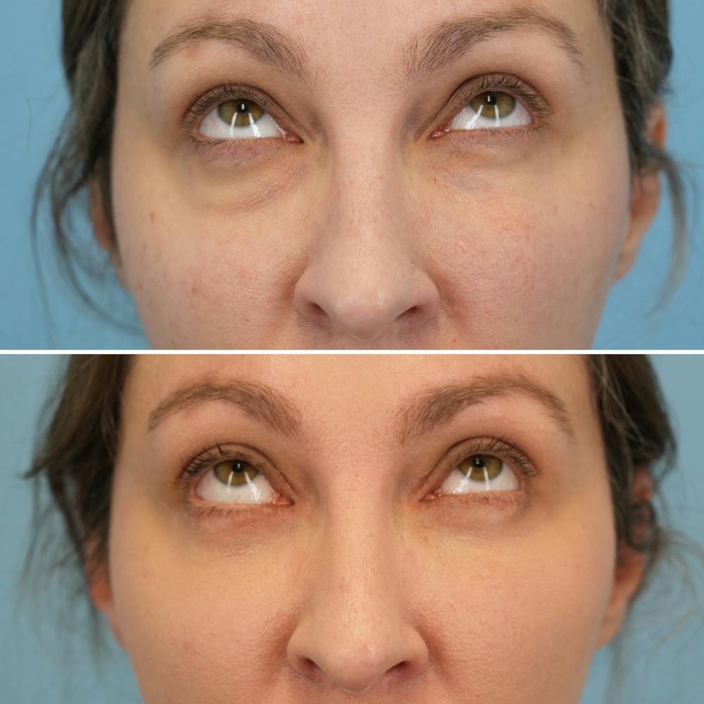 Blepharoplasty Before & After Gallery - Patient 369735 - Image 2