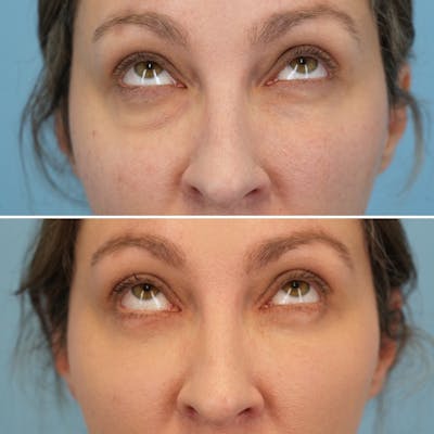 Blepharoplasty Before & After Gallery - Patient 369735 - Image 2