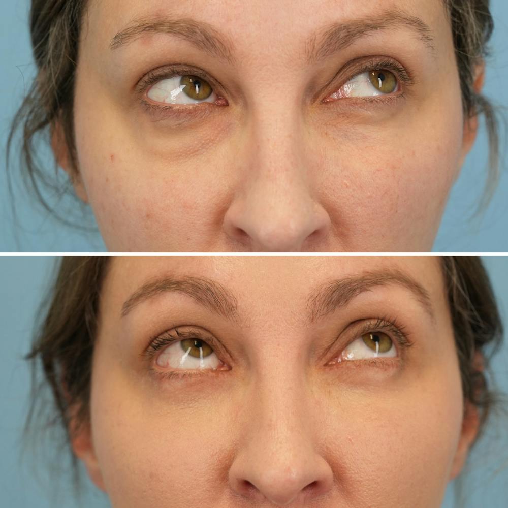 Blepharoplasty Before & After Gallery - Patient 369735 - Image 3