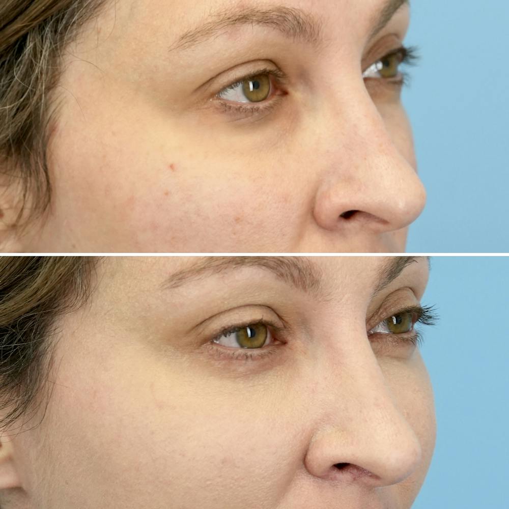 Blepharoplasty Before & After Gallery - Patient 369735 - Image 5