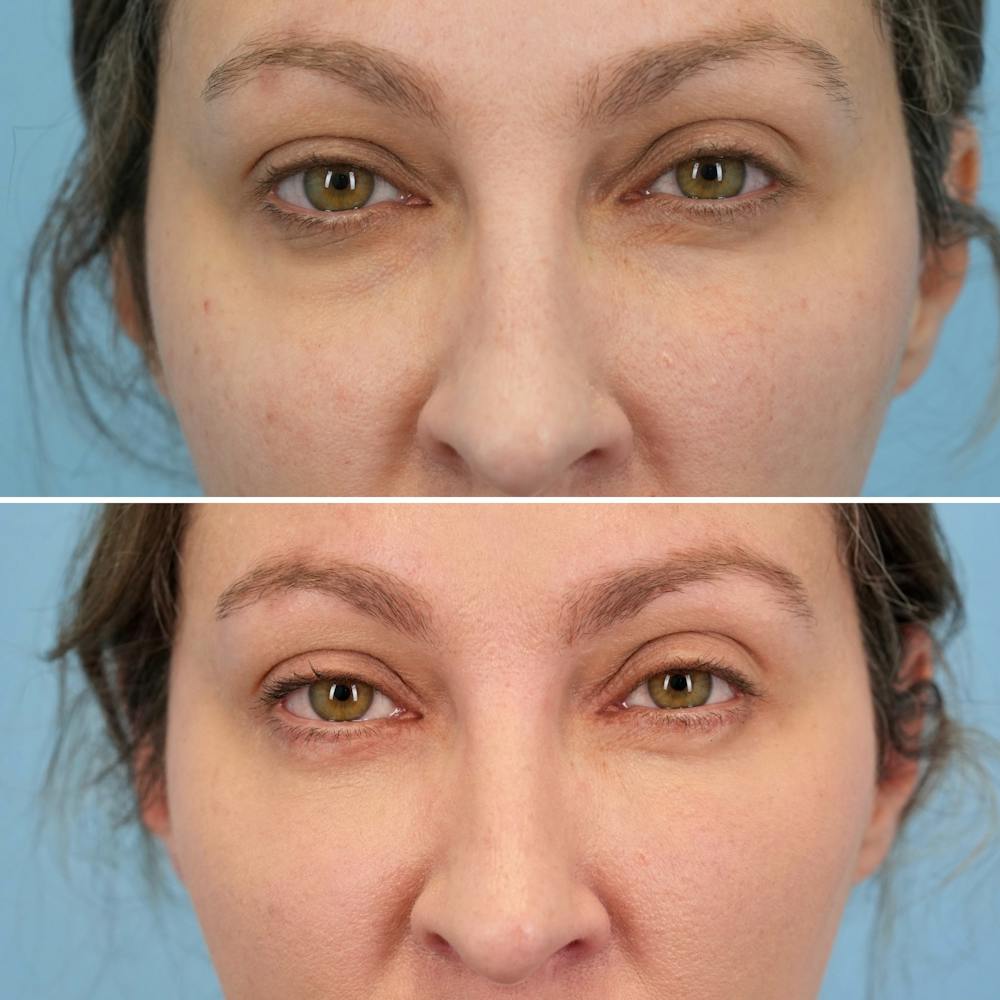 Blepharoplasty Before & After Gallery - Patient 369735 - Image 1