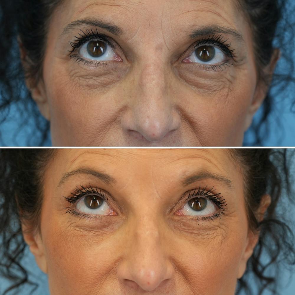 Blepharoplasty Before & After Gallery - Patient 126353 - Image 2