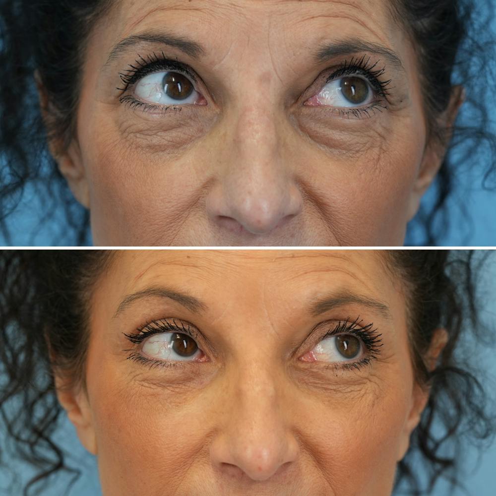 Blepharoplasty Before & After Gallery - Patient 126353 - Image 3