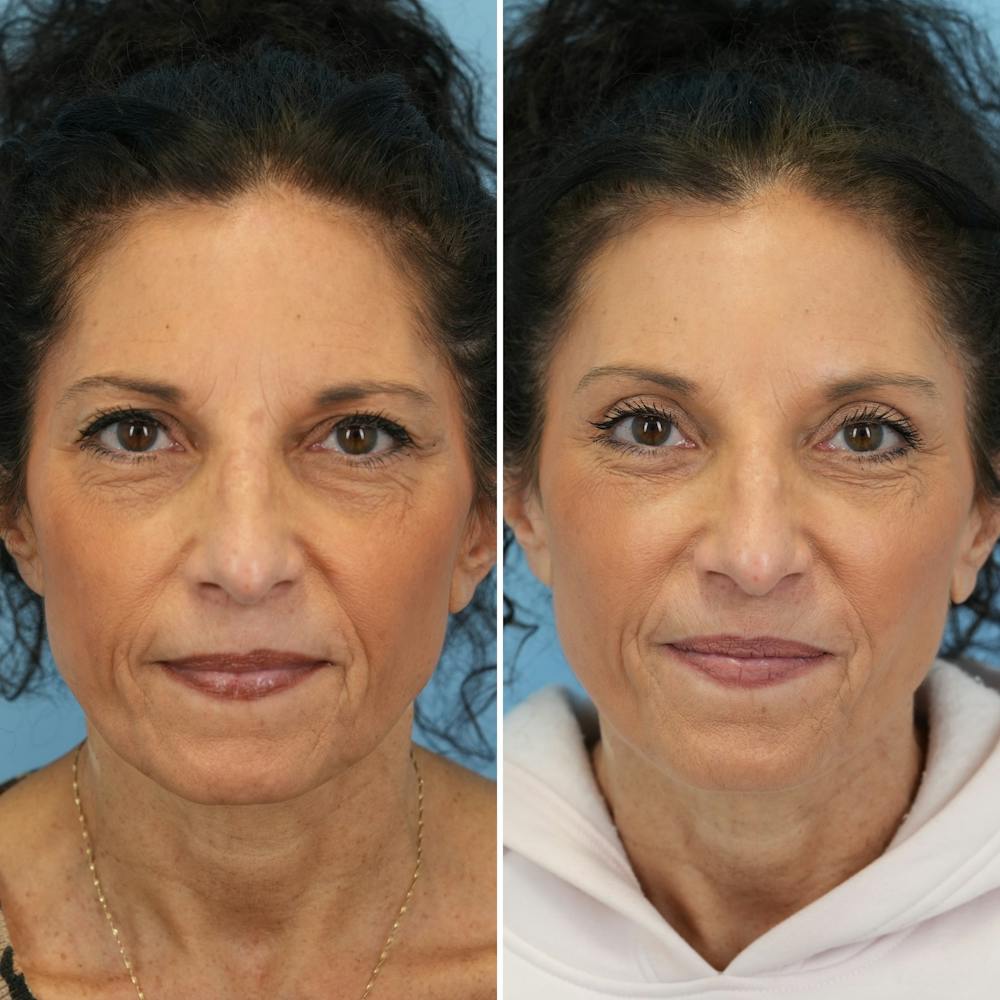 Blepharoplasty Before & After Gallery - Patient 126353 - Image 7