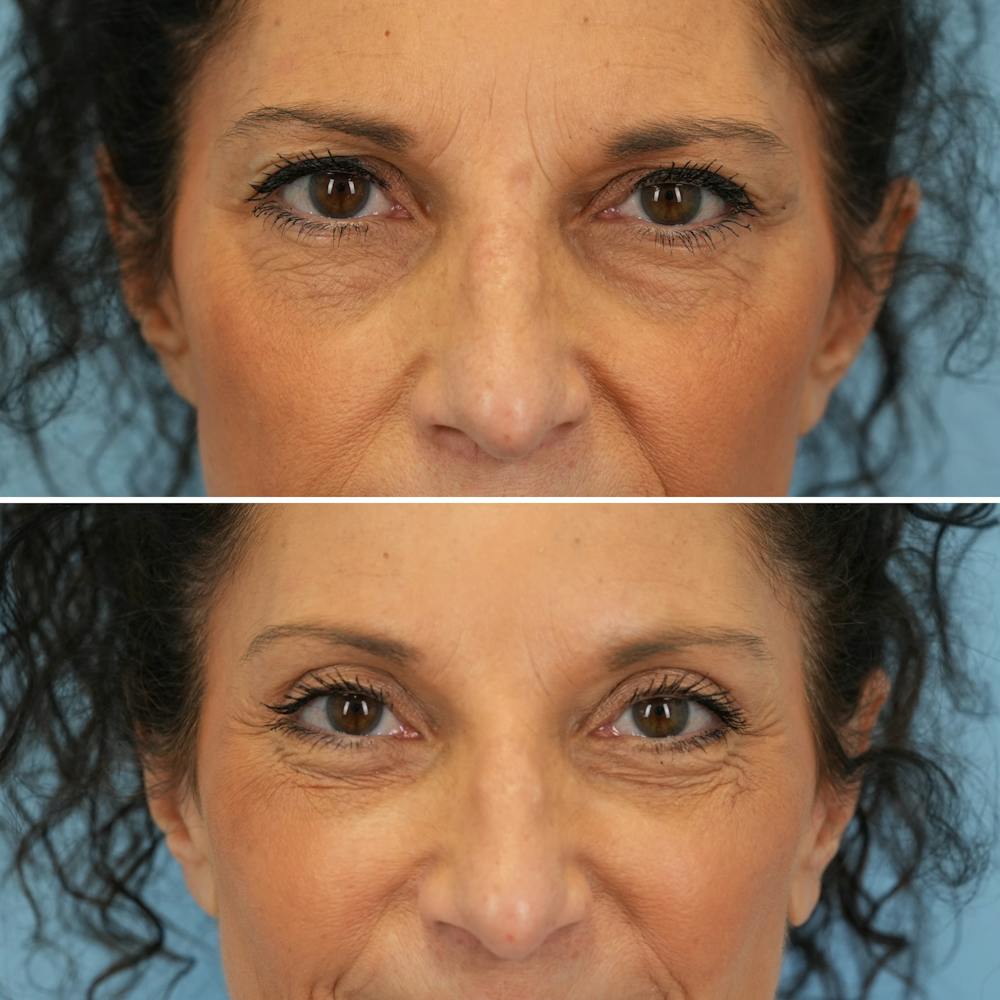 Blepharoplasty Before & After Gallery - Patient 126353 - Image 1