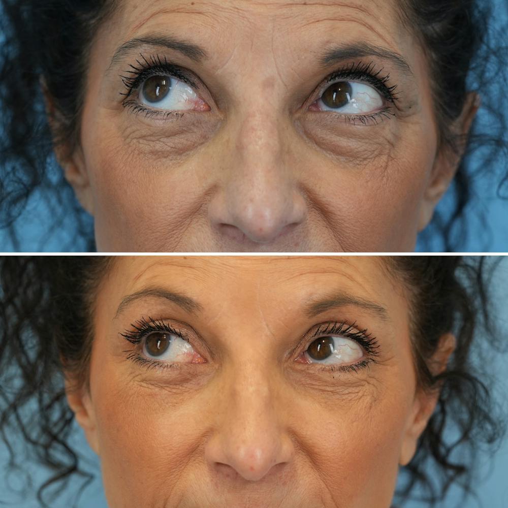 Blepharoplasty Before & After Gallery - Patient 126353 - Image 4