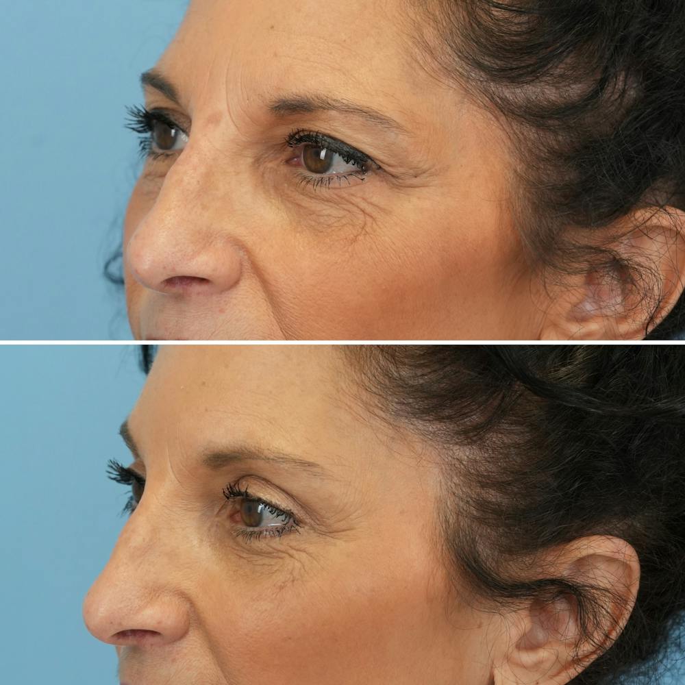 Blepharoplasty Before & After Gallery - Patient 126353 - Image 6