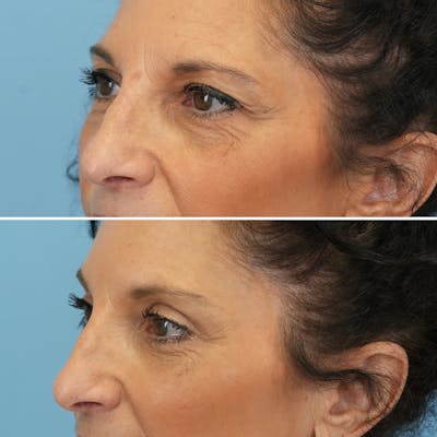 Blepharoplasty Before & After Gallery - Patient 126353 - Image 6