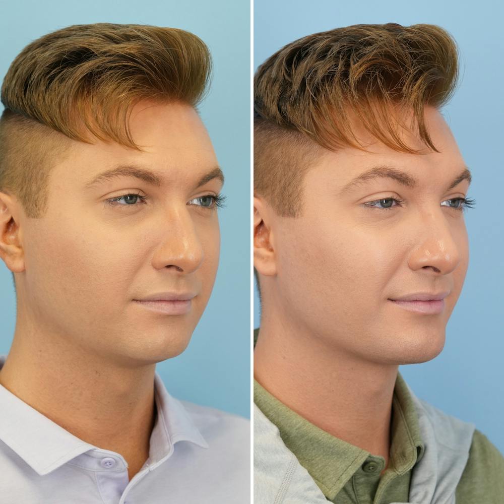 Chin Implant Before & After Gallery - Patient 190693 - Image 2
