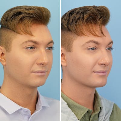 Chin Implant Before & After Gallery - Patient 190693 - Image 2