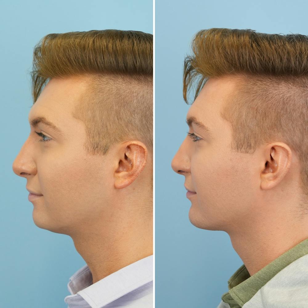 Chin Implant Before & After Gallery - Patient 190693 - Image 5