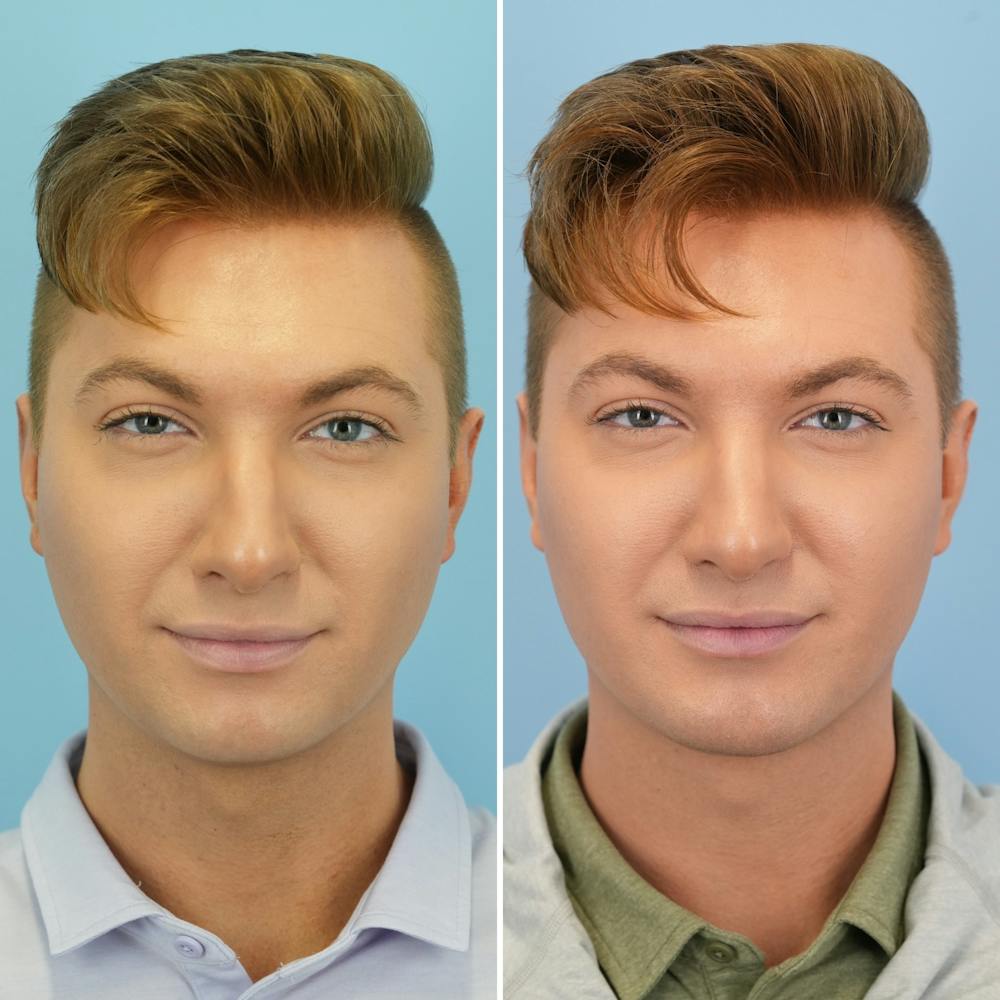 Chin Implant Before & After Gallery - Patient 190693 - Image 1